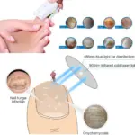 Fungus Therapy Pro Laser Nail Fungus Remover - Image 6